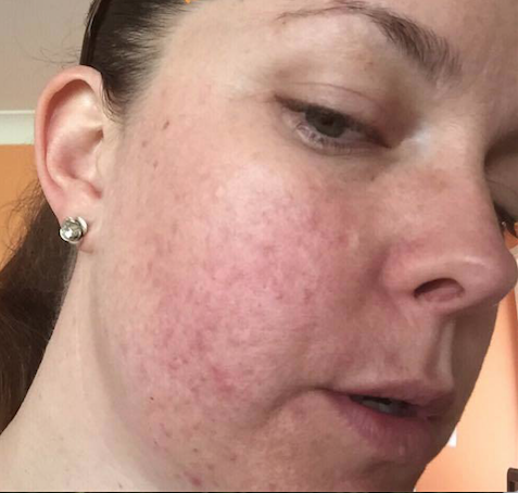 Spotlight on Rosacea